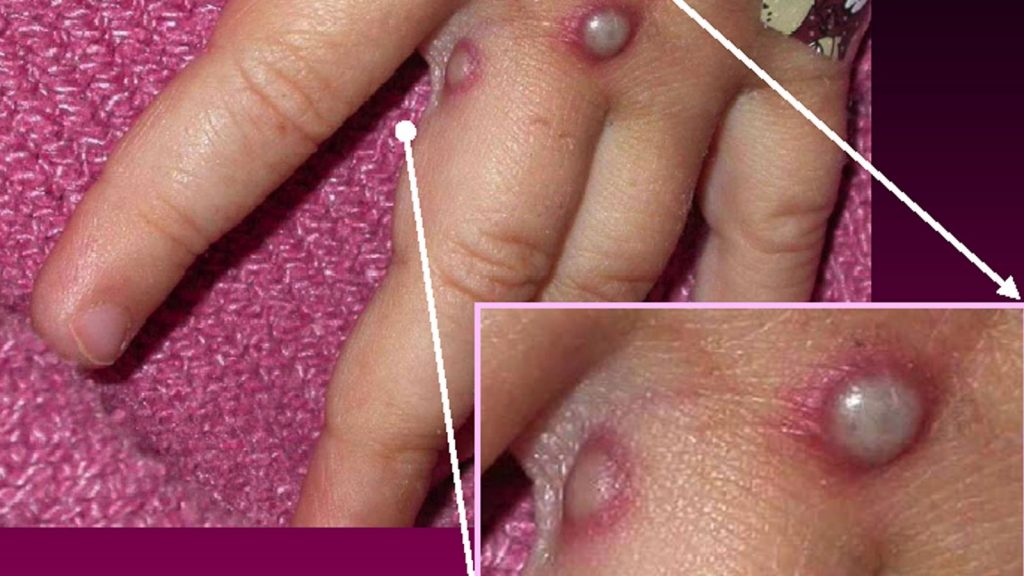 This image has an empty alt attribute; its file name is monkeypox-cases-spread-vaccine-release-cdc-1024x576.jpg